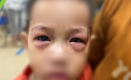 Đau mắt đỏ có xu hướng gia tăng, Bộ Y tế khuyến cáo 5 biện pháp phòng chống