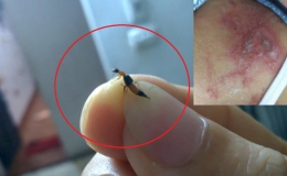 Nhiều trường hợp viêm da do kiến ba khoang